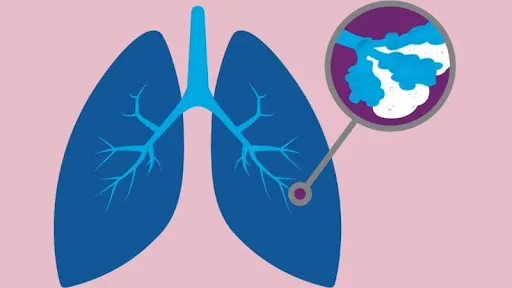 Phổi xơ hóa tái cấu trúc là nguyên nhân sâu xa dẫn đến viêm phổi
